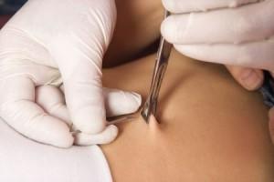 Bauchnabelpiercing stechen auf Hygiene achten beim Bauchnabelpiercing
